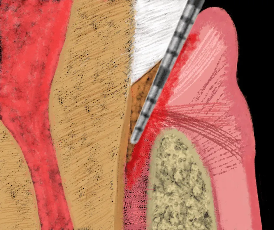 Periodontal pocket and probe drawing