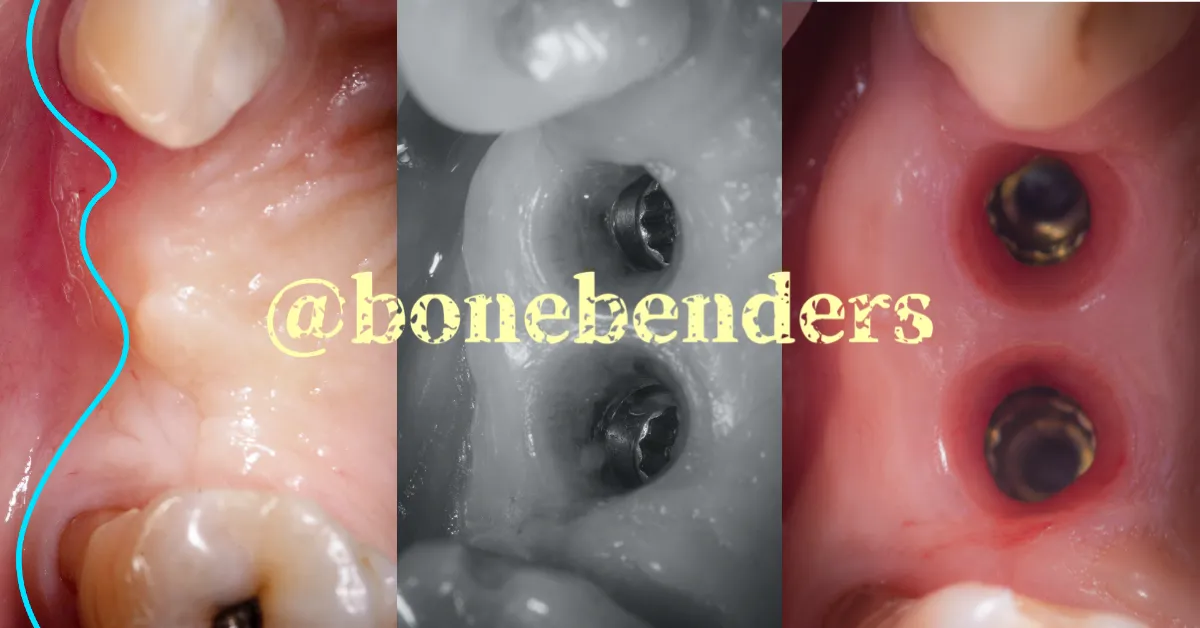 bonebending-100-osso-100-cheratinizzata