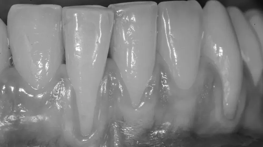 Immagine ravvicinata di denti con evidenti recessioni gengivali, mostrando la radice esposta e la mancanza di gengiva protettiva sulle superfici dentali.