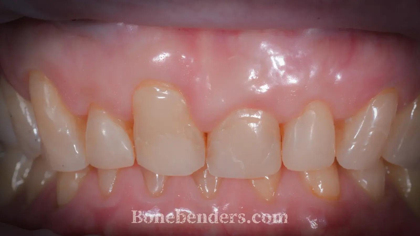 Recessione gengivale sull'incisivo centrale superiore destro (1.1), dente vestibolarizzato e usurato, margini gengivali disallineati — fotografia intraorale pre-operatoria