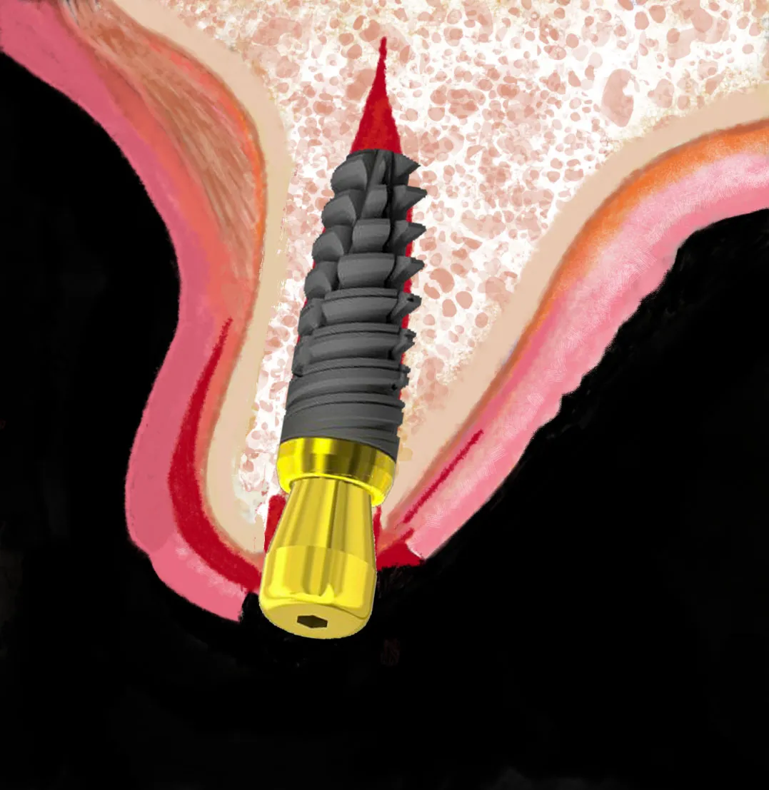 deficit-ossei-orizzontali-la-meta-analisi-su-1-400-impianti