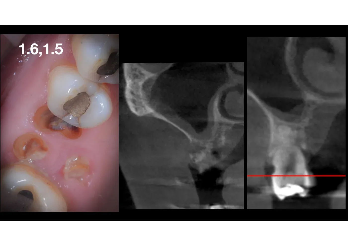 Foto intraorale dei residui radicolari di 1.6 e 1.5 e due sezioni CBCT che mostrano il pavimento del seno mascellare basso con altezza ossea residua critica
