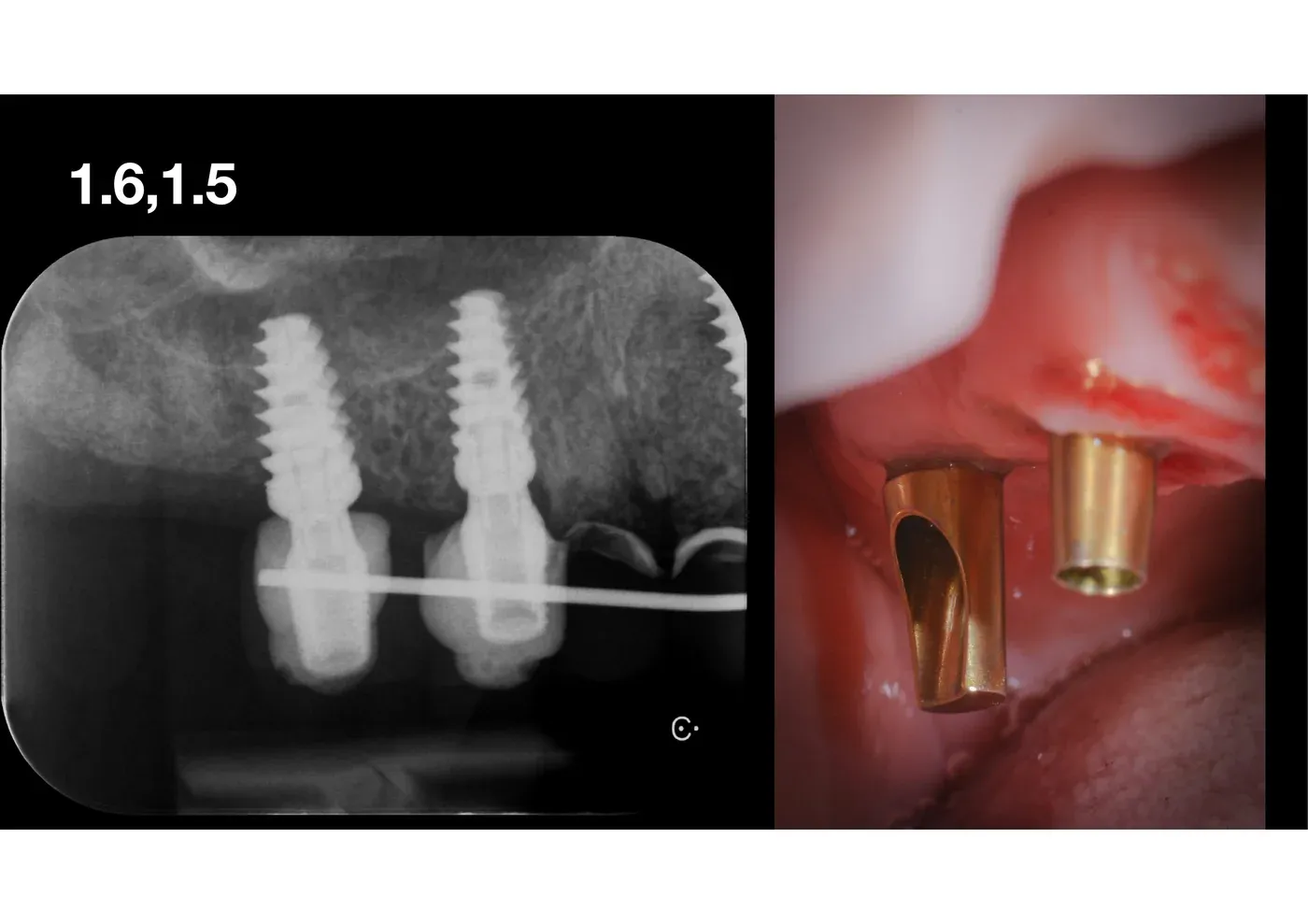 Radiografia di controllo a guarigione avvenuta e foto clinica con monconi provvisori dorati