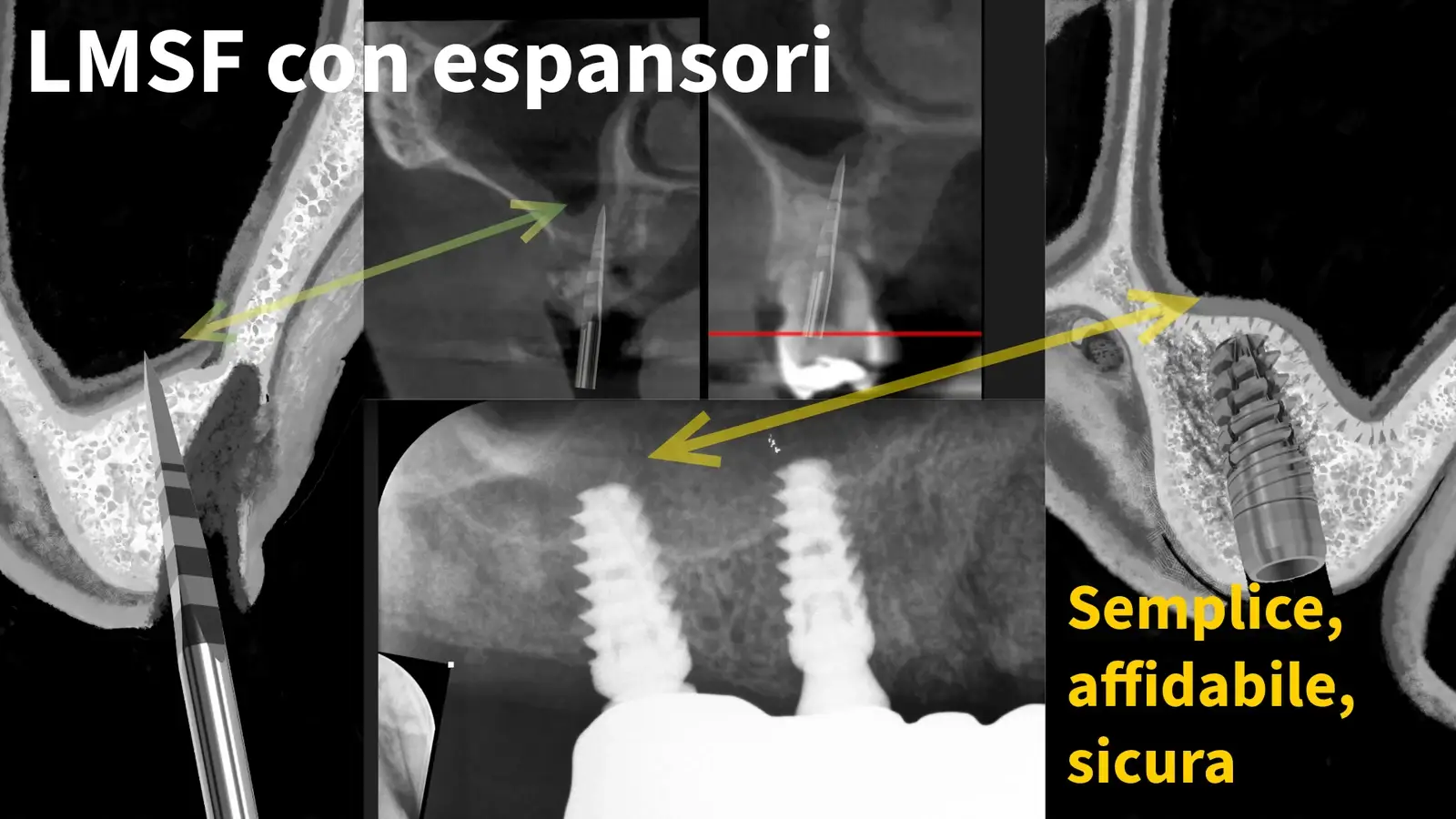 Cover editoriale «LMSF con espansori — semplice, affidabile, sicura»: composito di sezioni CBCT, espansori a vite ed esiti radiografici dei due impianti integrati nel seno rialzato senza innesto