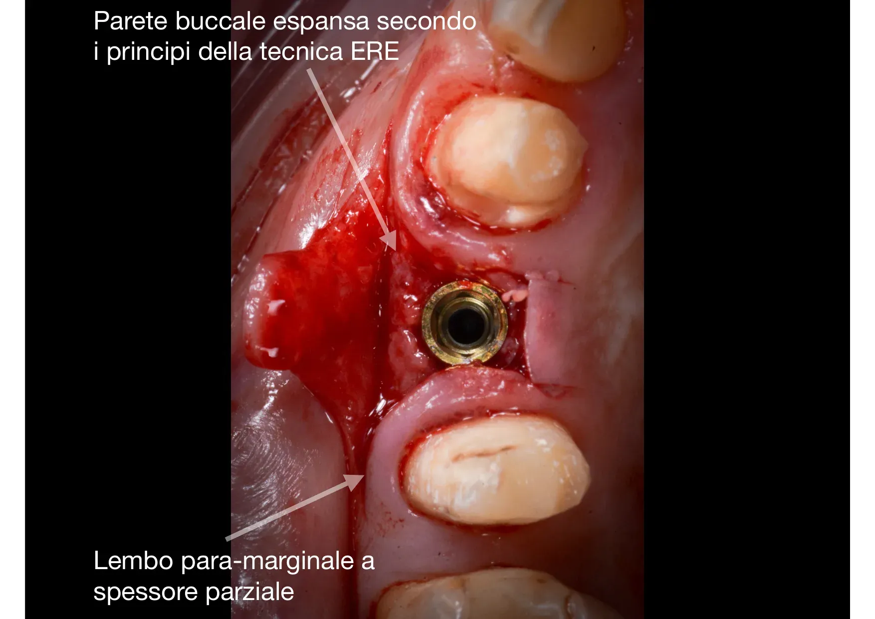 Fase intraoperatoria: parete buccale espansa secondo i principi della tecnica ERE, lembo para-marginale a spessore parziale, impianto tissue level in sede