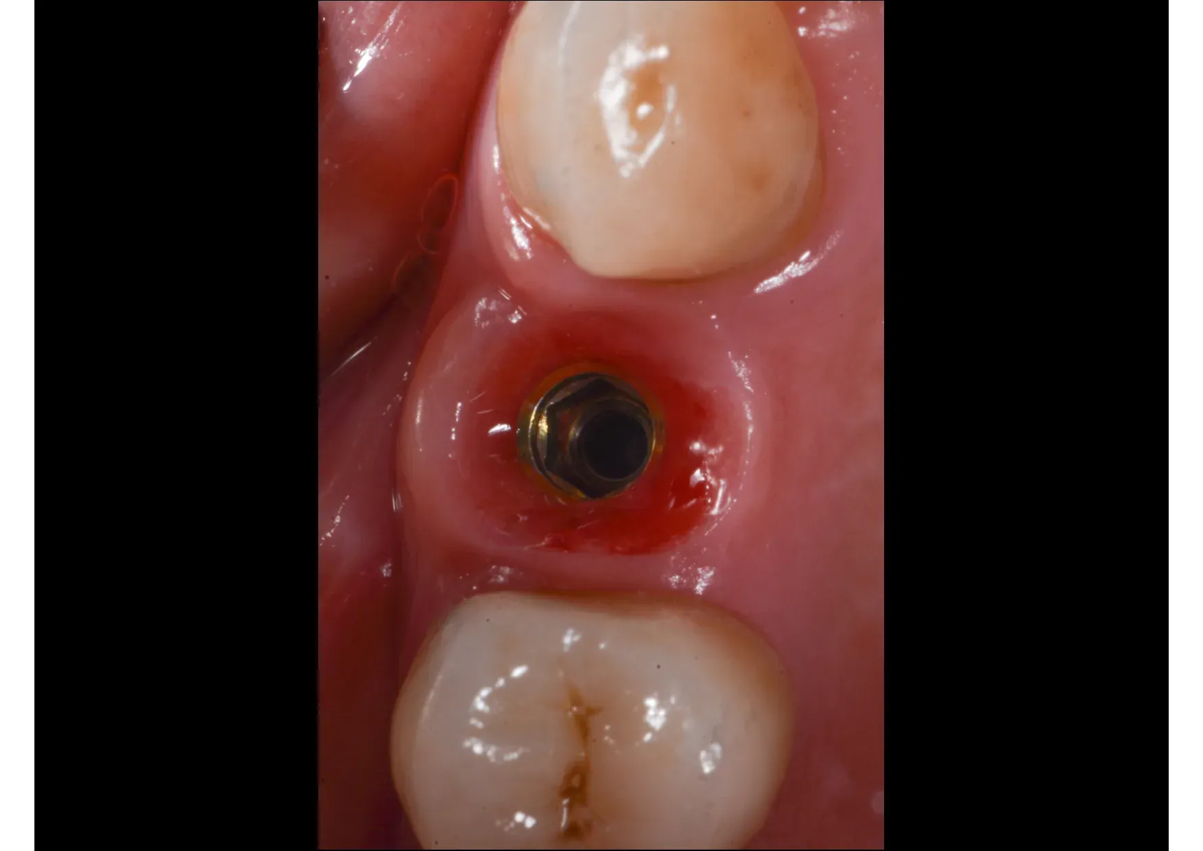 Dettaglio del tessuto perimplantare maturo: mucosa cheratinizzata sana attorno all'emergenza implantare
