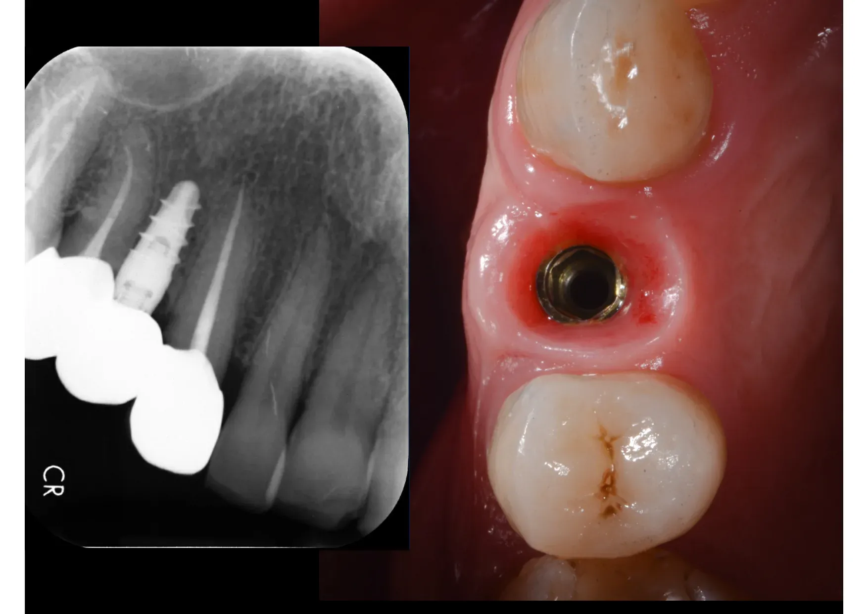 Radiografia periapicale con livelli ossei stabili e visione occlusale dei tessuti perimplantari sani