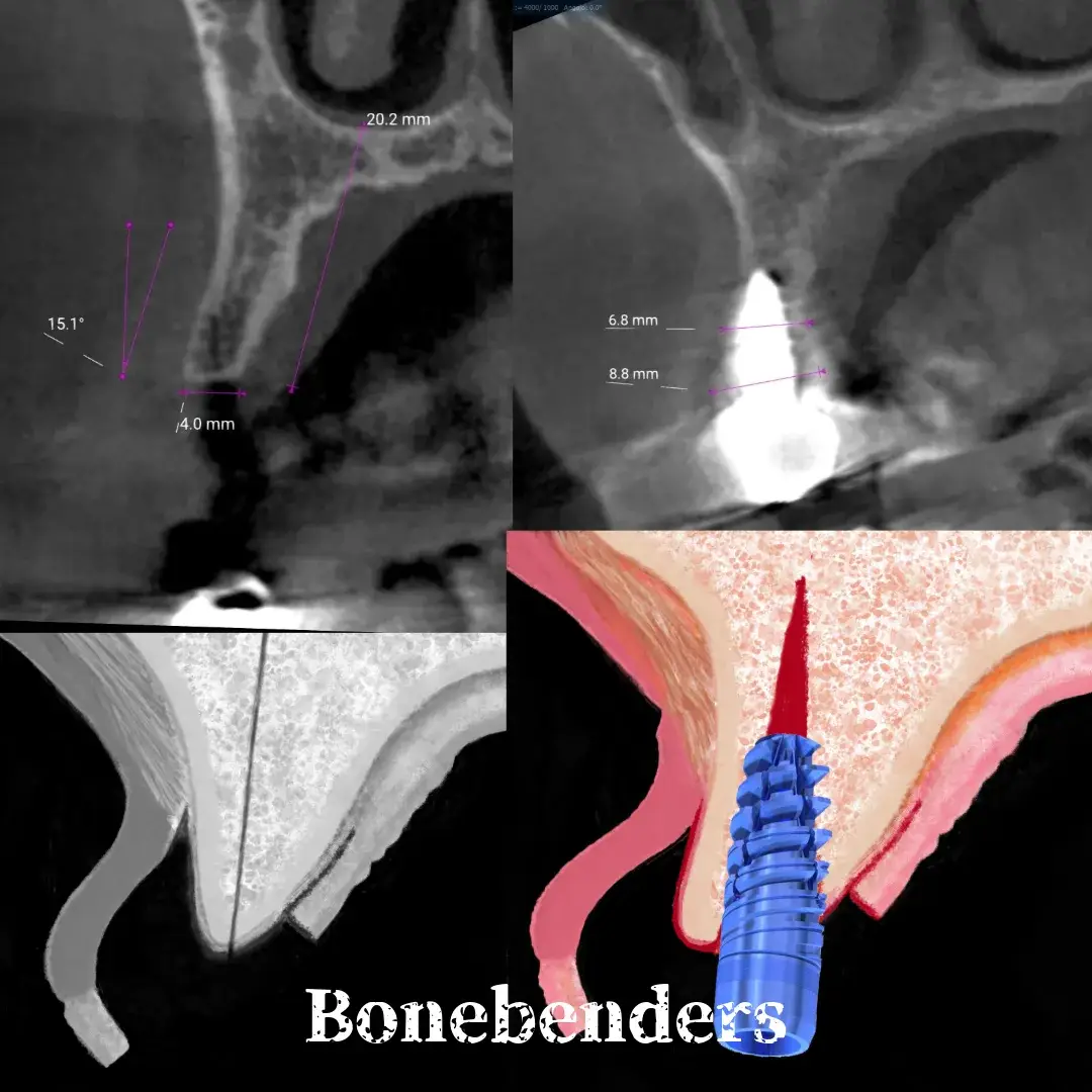 CBCT e illustrazione della tecnica di espansione crestale ERE con impianto immediato
