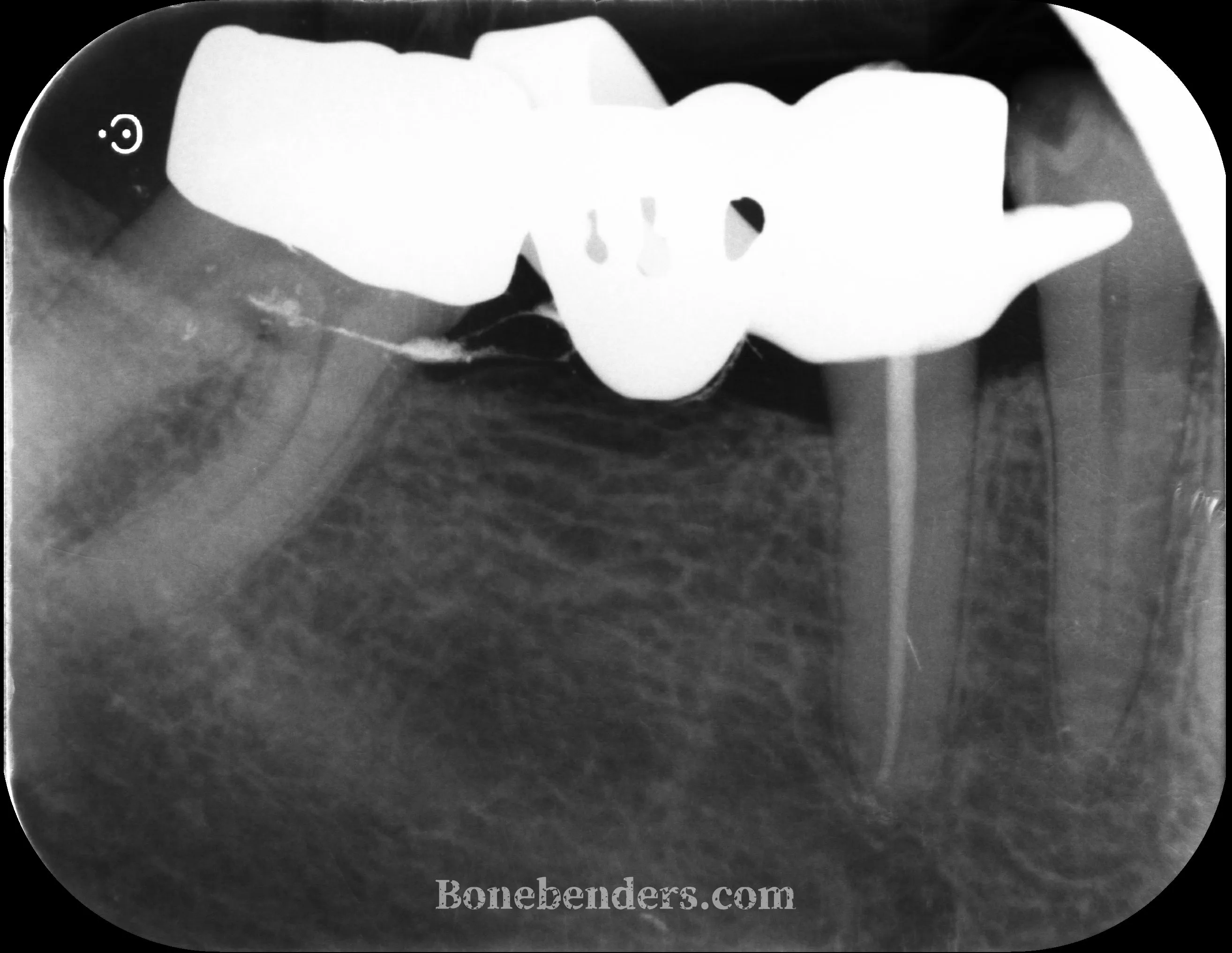 Radiografia periapicale pre-operatoria del sito 4.6 durante il trattamento endodontico dei denti adiacenti, prima dell'espansione osteo-mucosa.
