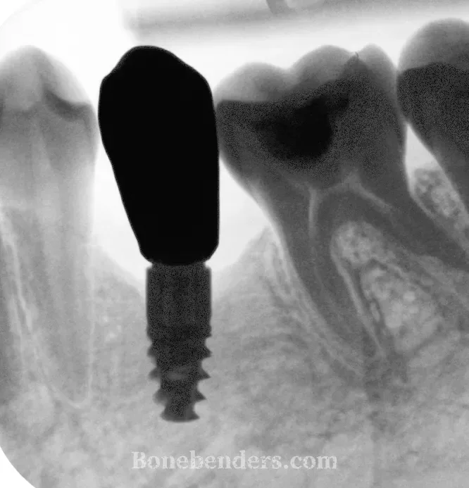 Radiografia periapicale di controllo a 12 mesi, a contrasto invertito: impianto osteointegrato in zona premolare inferiore sinistro dopo espansione crestale ERE