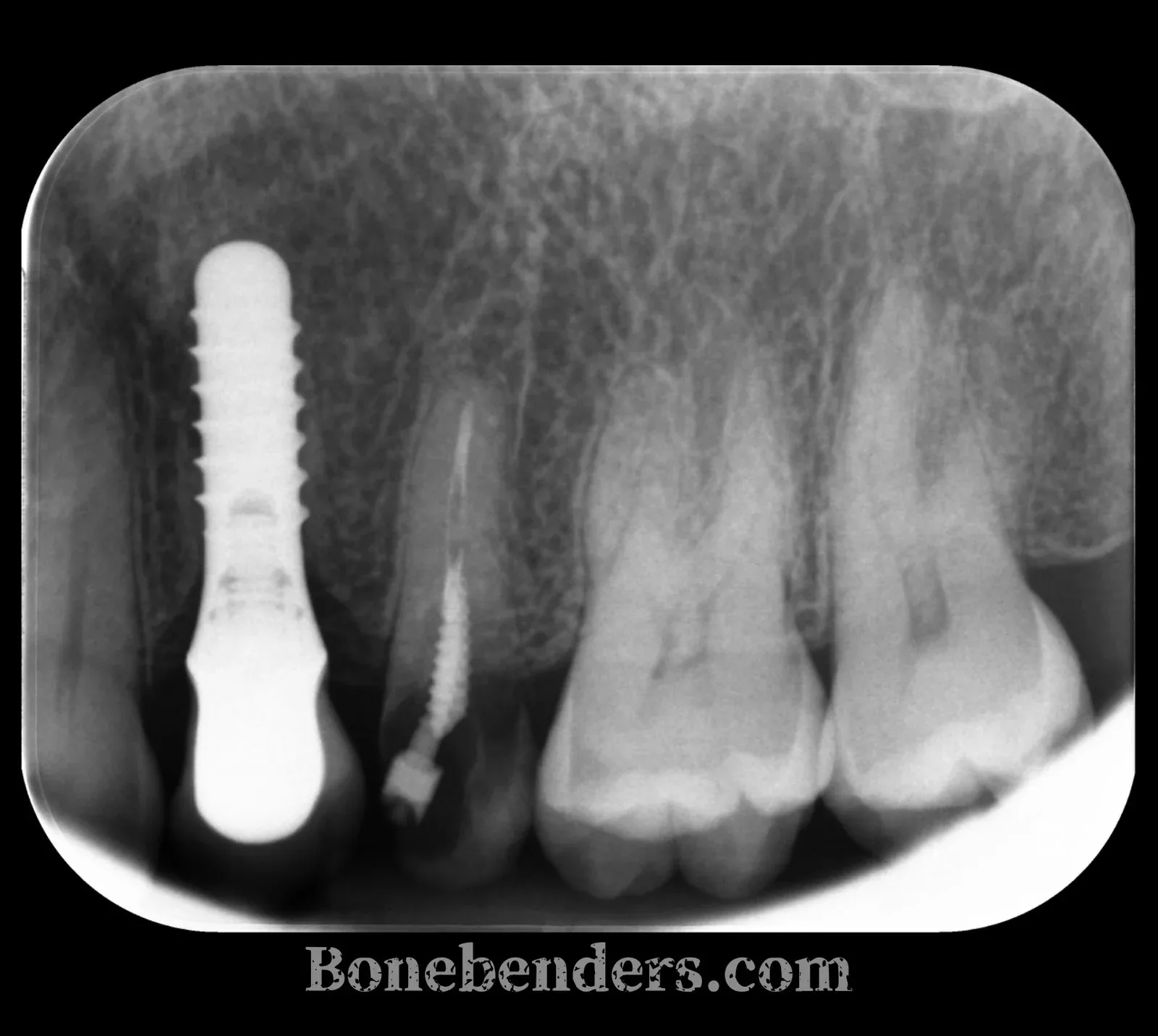 Radiografia periapicale pre-operatoria del settore superiore sinistro: elemento 2.5 trattato endodonticamente con perno, da sostituire con impianto post-estrattivo; accanto un impianto già presente