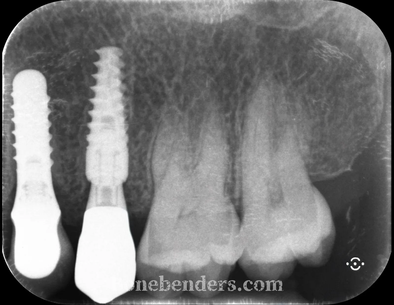 Radiografia periapicale di controllo a 3 mesi: impianto post-estrattivo in zona 2.5 osteointegrato, accanto all'impianto preesistente
