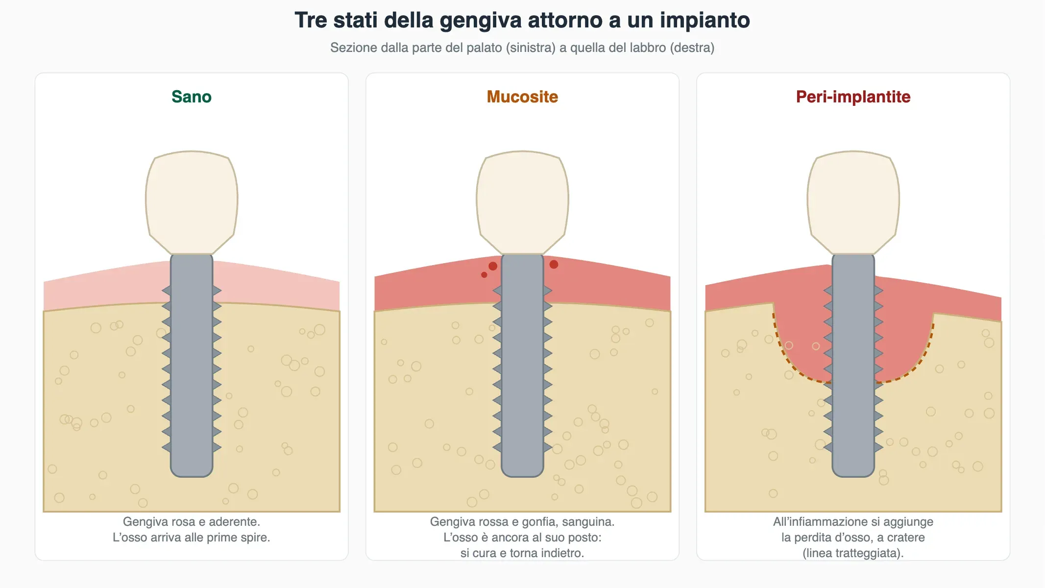 Schema di tre impianti in sezione: gengiva sana, gengiva infiammata con osso conservato (mucosite) e perdita d'osso a cratere (peri-implantite).