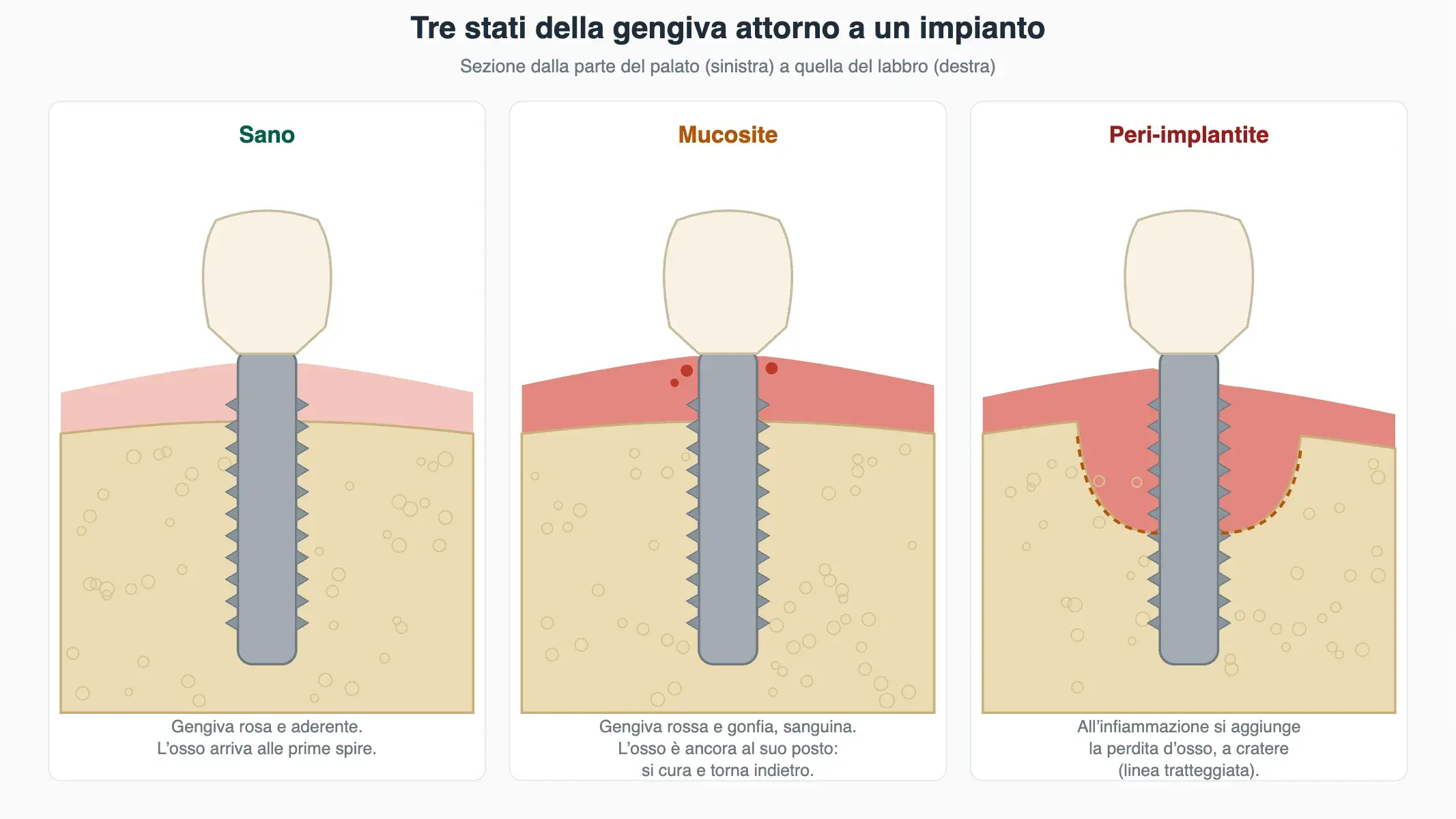 Schema di tre impianti in sezione: gengiva sana, gengiva infiammata con osso conservato (mucosite) e perdita d'osso a cratere (peri-implantite).