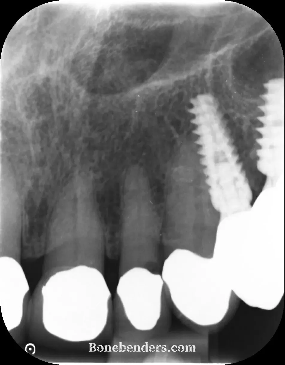 Radiografia endorale pre-operatoria del 22: carie estesa sotto la corona, nessuna lesione periapicale; distalmente due impianti osteointegrati