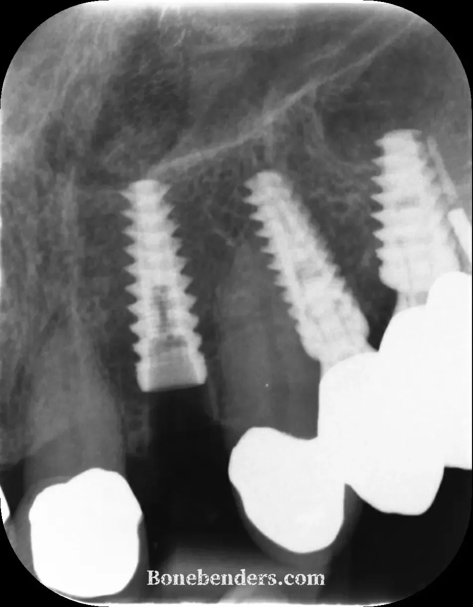 Radiografia endorale subito dopo l'inserimento: impianto da 4,25 × 13 mm in posizione palatale e apicale, con l'apice sulla corticale del pavimento nasale