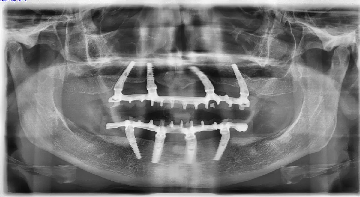 implantologia-a-carico-immediato-tecnica-vantaggi-e-quando-e-indicata