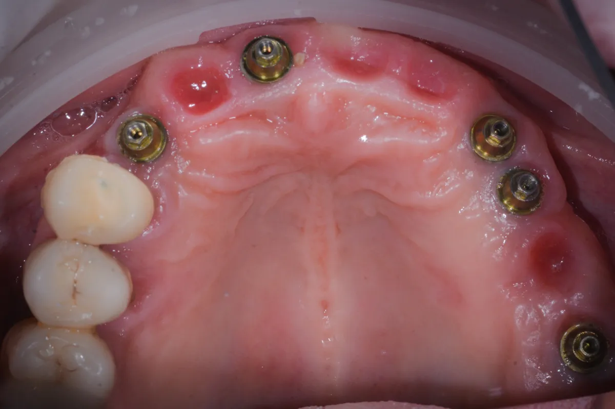 la-storia-di-un-amico-come-correggere-una-protesi-su-impianti-che-non-regge-piu