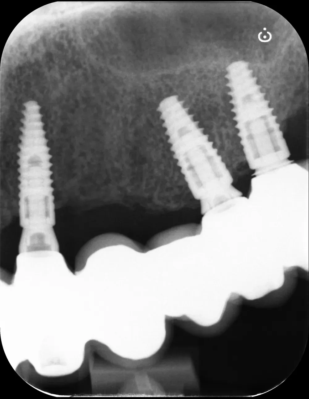 RX periapicale premaxilla sinistra