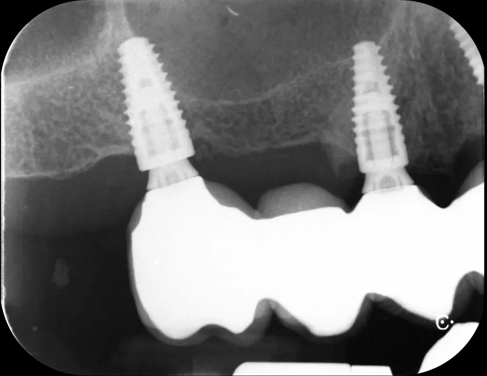 RX periapicale mascellare destra