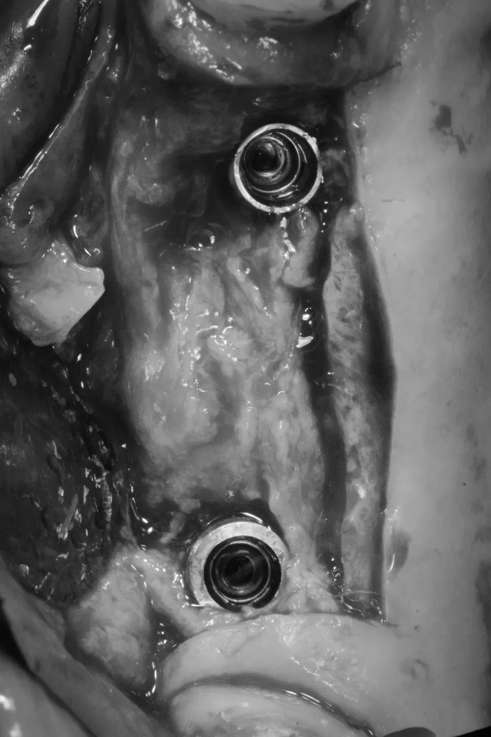 Inserimento impianti 14 - 16