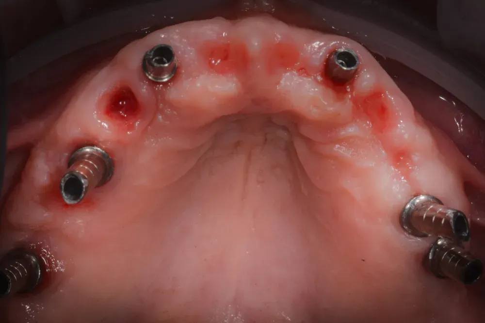 Arcata superiore al temine del trattamento prima di fissare il ponte in ceramica