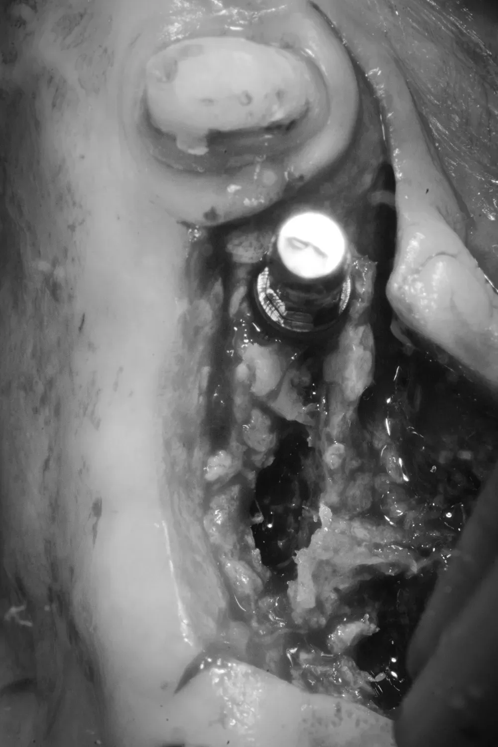 Mascellare sinistro intra-operatoria con espansione osteo-mucosa