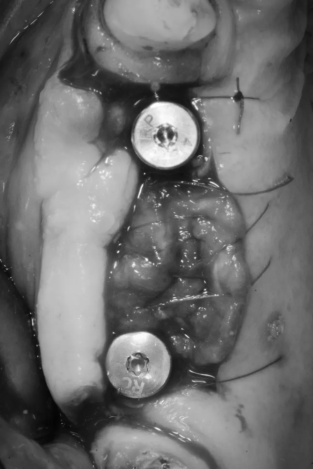 Chiusura lembo superiore destro