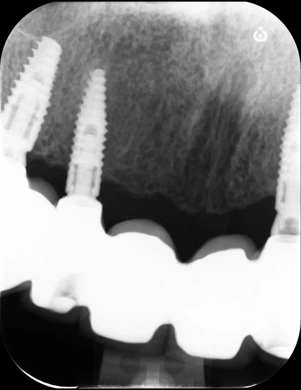 RX periapicale premaxilla destra