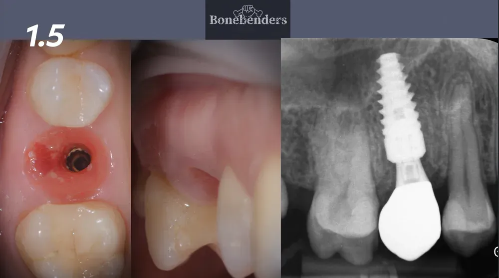 Risultato finale impianto a carico immediato con conservazione profili emergenza tramite chamber concept