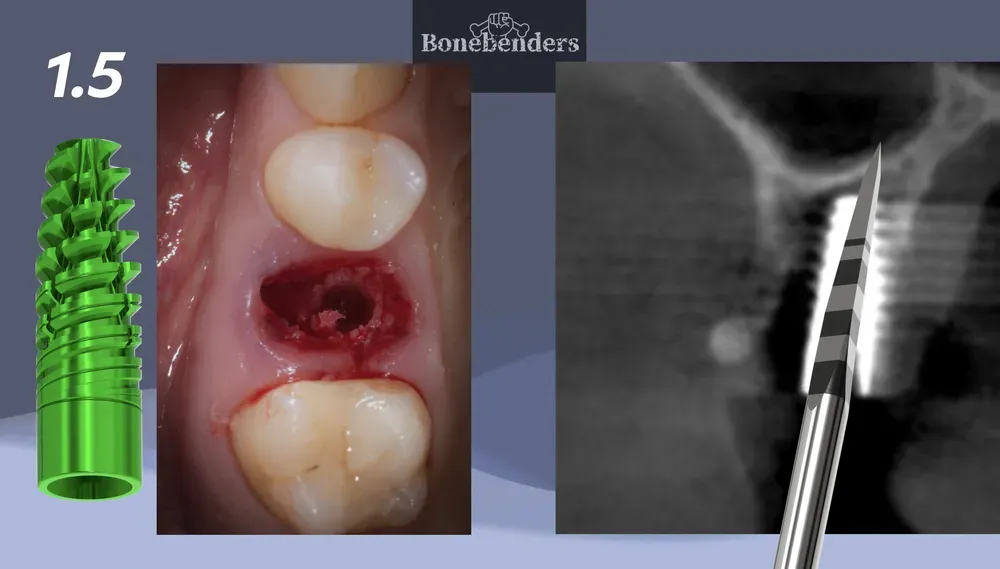 Uso della fresa lanceolata modificata durante intervento di carico immediato con verifica CBCT intraoperatoria
