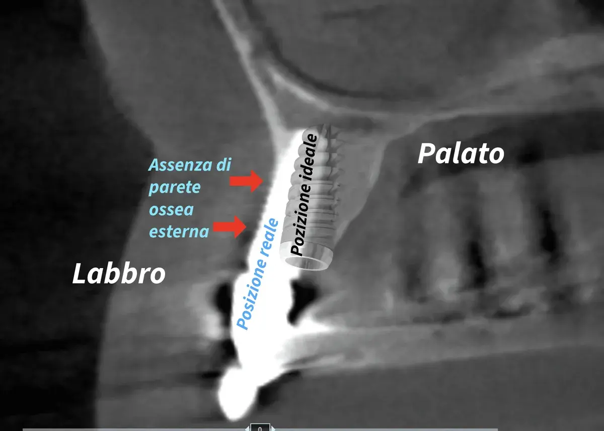 Impianto dentale storto o mal posizionato: rischi e soluzioni