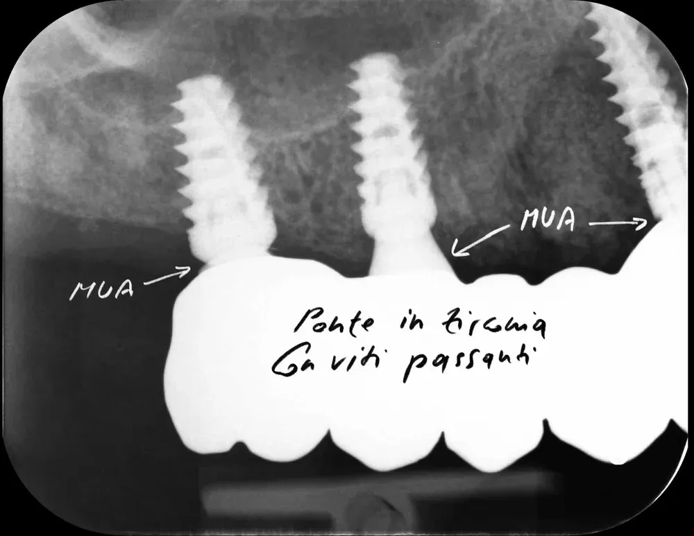 Radiografia di un ponte su impianti realizzato con MUA intermedi tra la struttura in zirconia e gli impianti stessi.