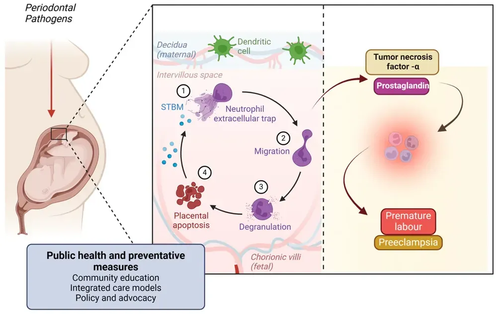 Diagramma che illustra il meccanismo attraverso cui i patogeni parodontali possono influenzare la gravidanza, collegando la salute orale agli esiti avversi come il parto prematuro e la preeclampsia.