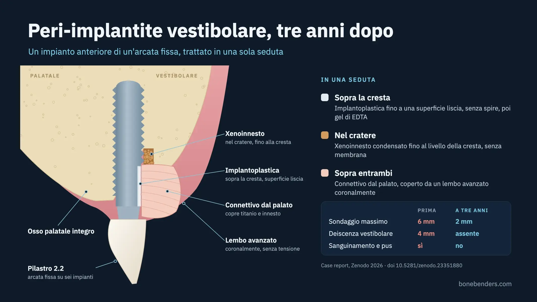 Schema in sezione di un impianto con peri-implantite trattata, con la superficie vestibolare levigata, granuli di xenoinnesto nel difetto infraosseo, e un innesto di connettivo che copre il titanio.