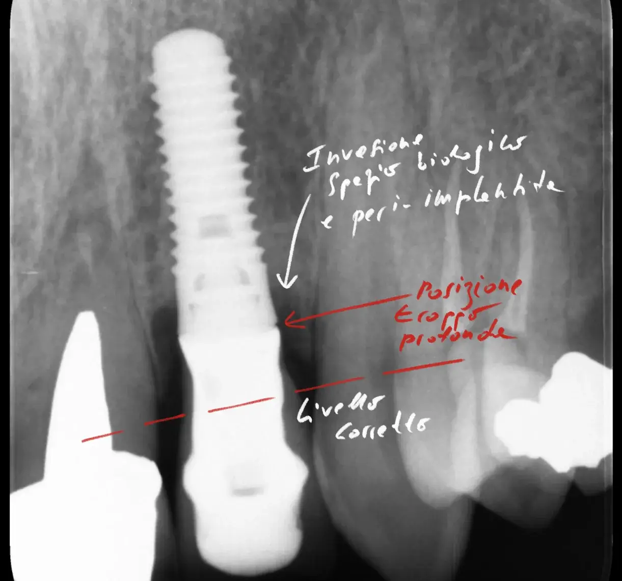 Radiografia di un impianto affetto da peri-implantite da posizionamento errato