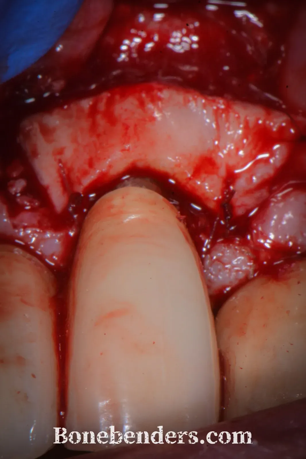 Innesto di connettivo subepiteliale prelevato dal palato, posizionato sopra il difetto innestato e la superficie implantare trattata, fissato con suture