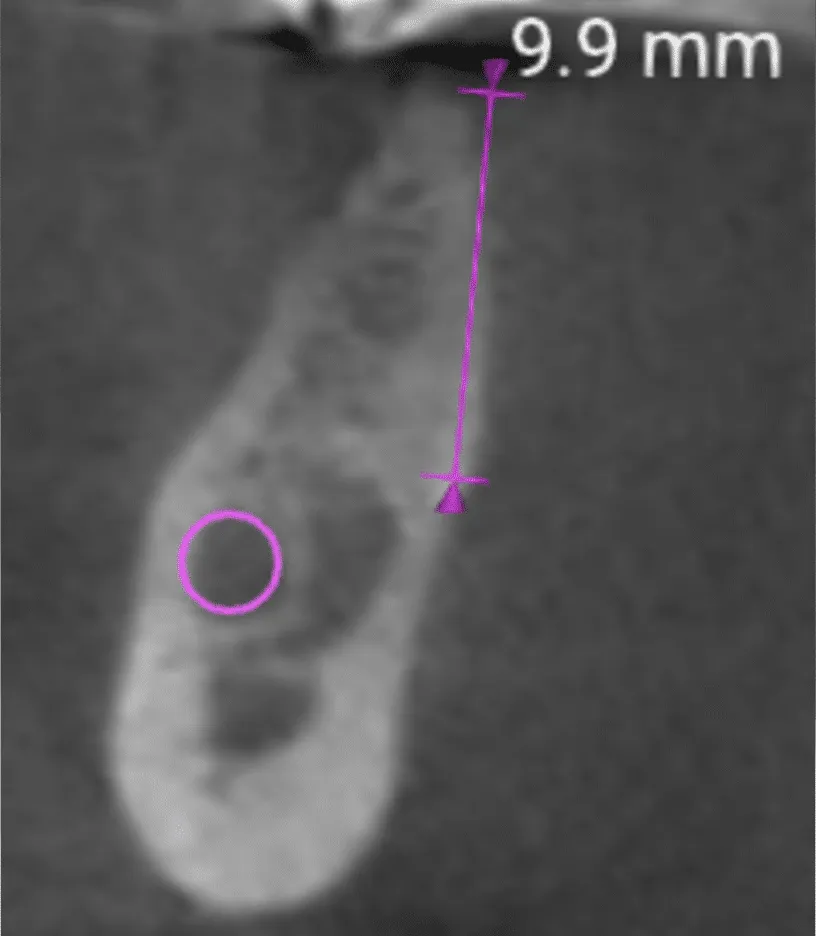 poco-osso-per-limpianto-difficile-che-sia-veramente-cosi