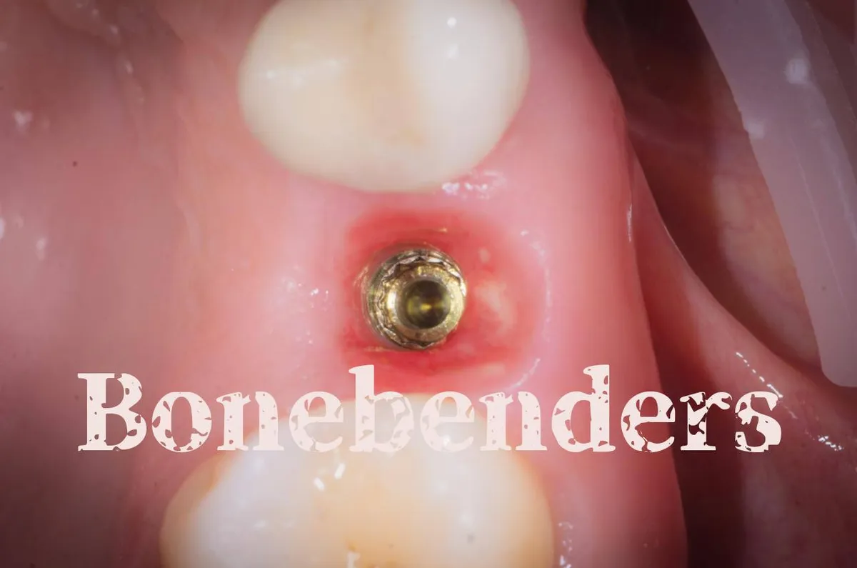 quali-sono-i-vantaggi-principali-del-bonebending-rispetto-alla-rigenerazione-ossea-alveolare-tradizionale