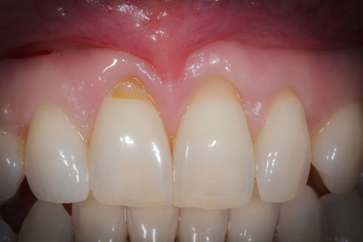 quando-occorre-un-innesto-gengivale-e-quando-no