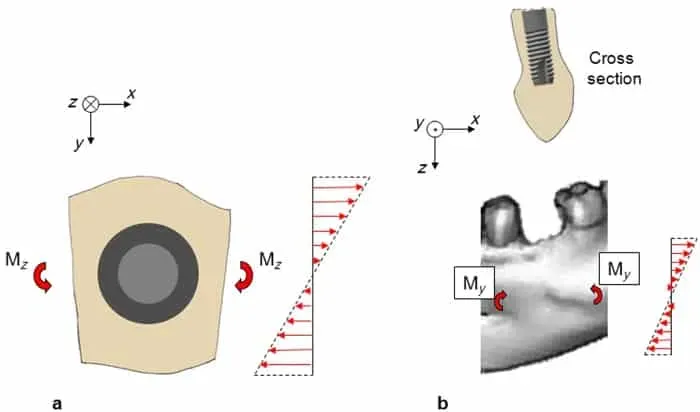 Diagramma che mostra forze e coppie Mz e My su una sezione trasversale di un oggetto. Mandibola con impianto.