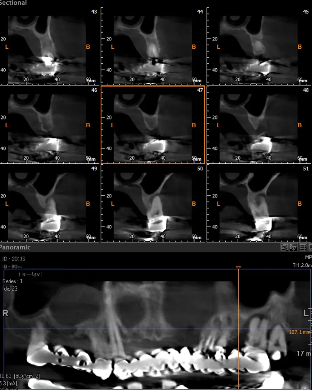 CBCT lato sinistro