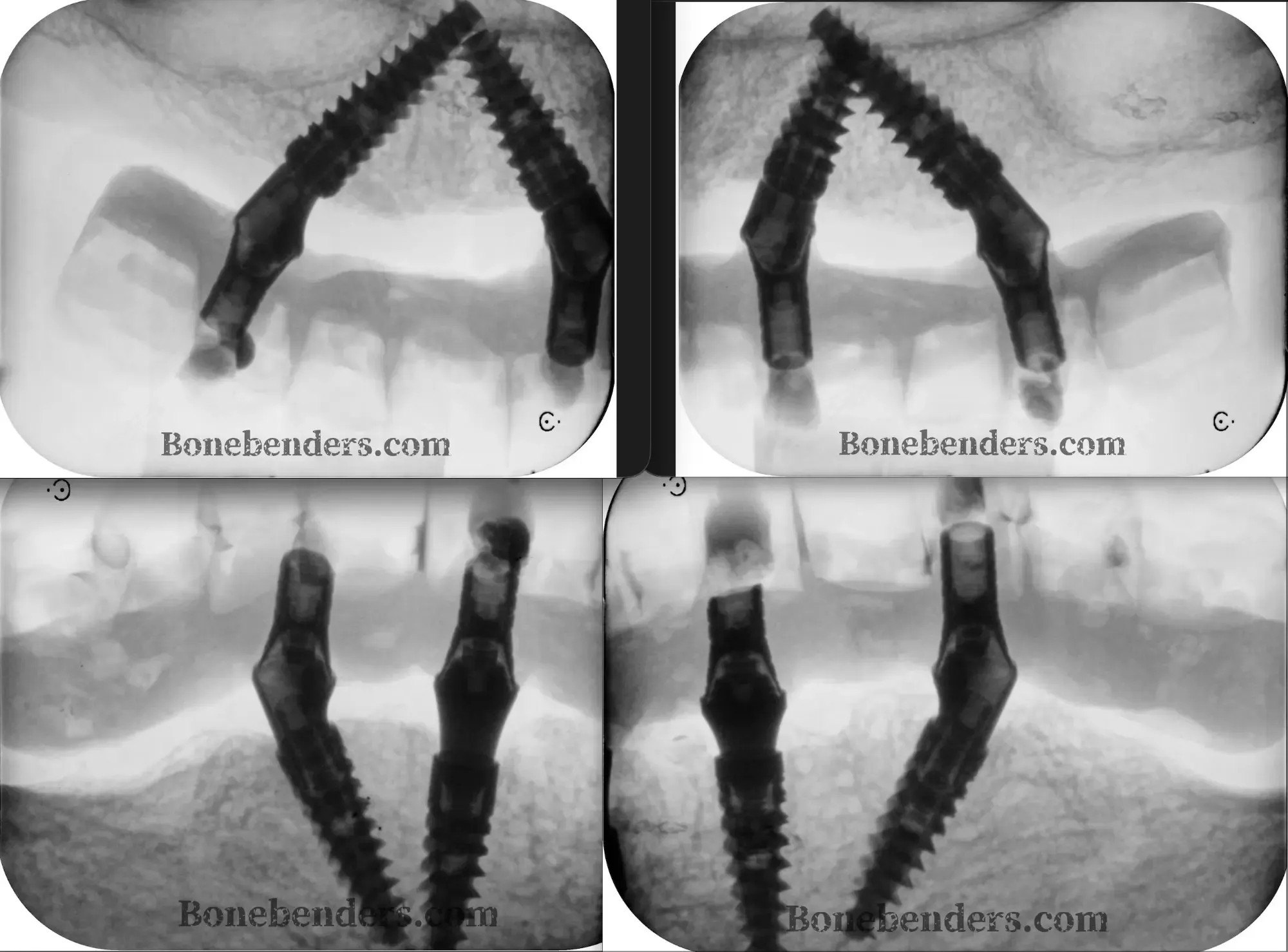 Four inverted-contrast periapical radiographs at the three-year follow-up: the two upper quadrants above and the two lower quadrants below, each with the tilted distal implant and the anterior implant under the fixed prosthesis