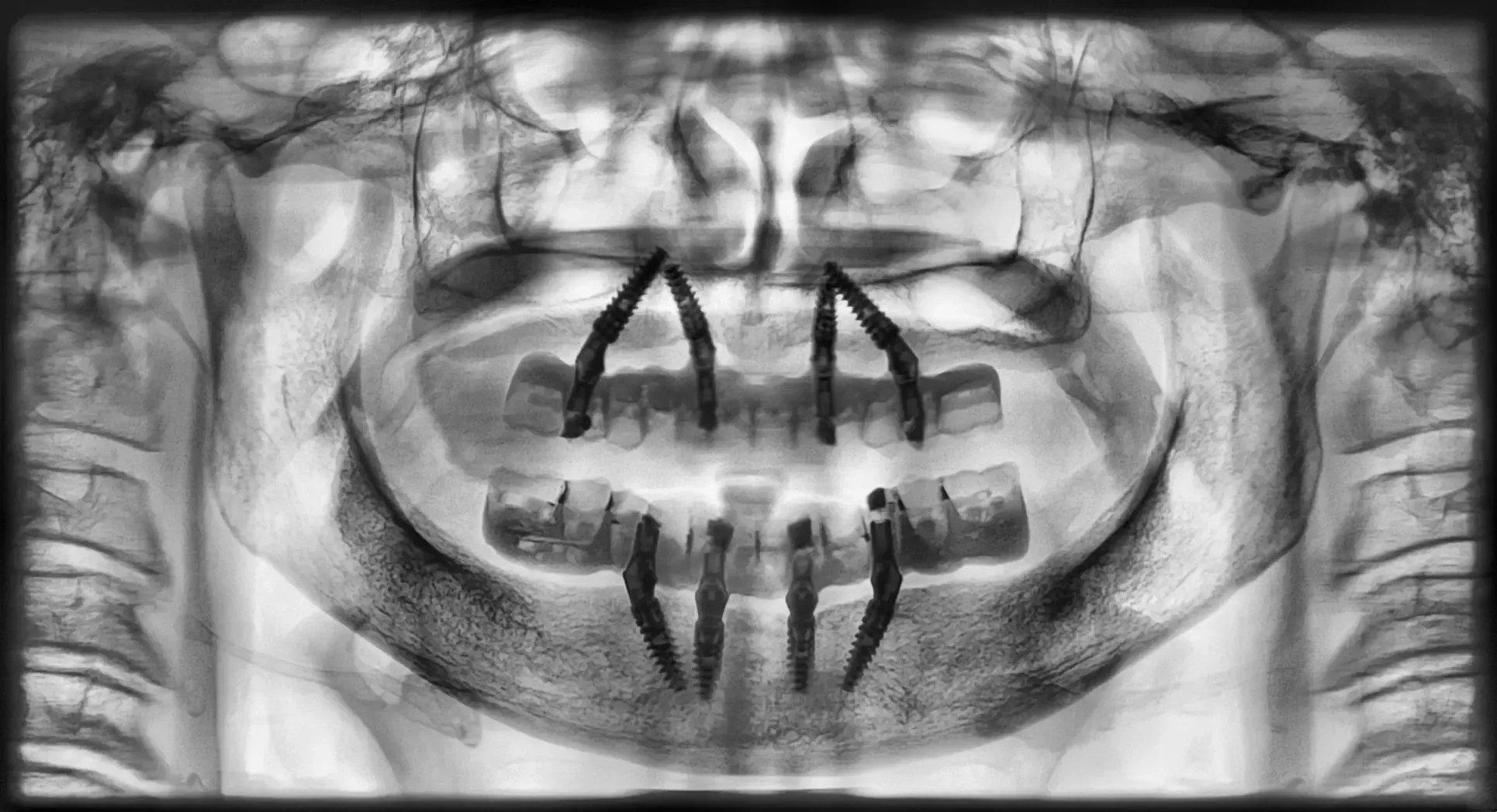 Panoramica a contrasto invertito a sei mesi: quattro impianti per arcata, i distali inclinati lungo la parete anteriore dei seni e davanti ai forami mentonieri, sotto due protesi fisse avvitate