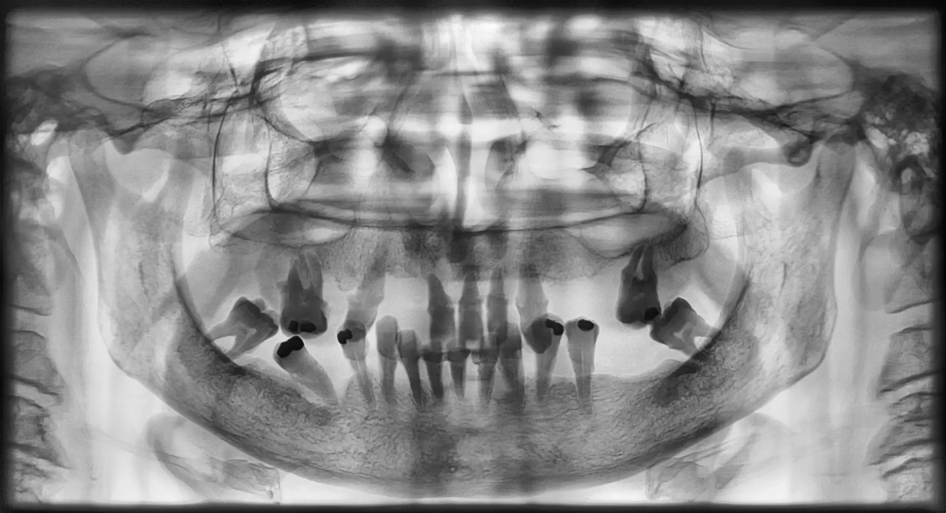 Inverted-contrast preoperative panoramic radiograph showing compromised residual dentition in both arches