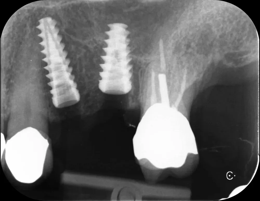 Rx Periapicale Post-op