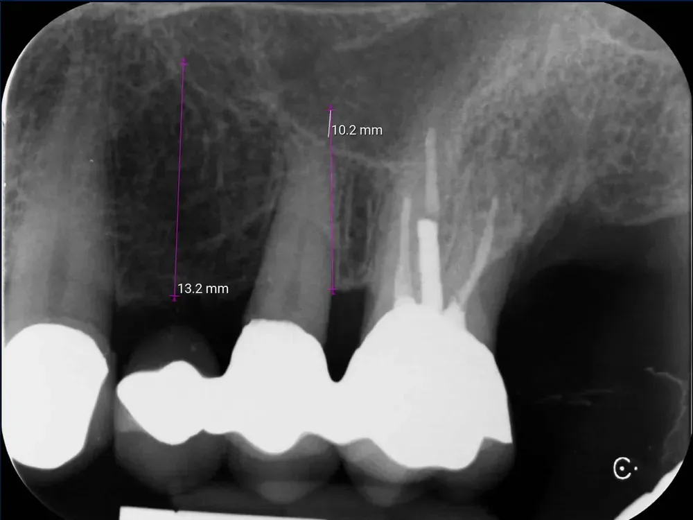 Radiografia dentale periapicale preoperatoria di un elemento di ponte con carie profonda tasca parodontale e ascesso acuto non trattabile.