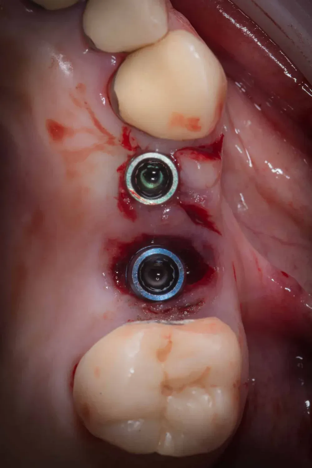 Strumenti espansori da 13mm in posizione