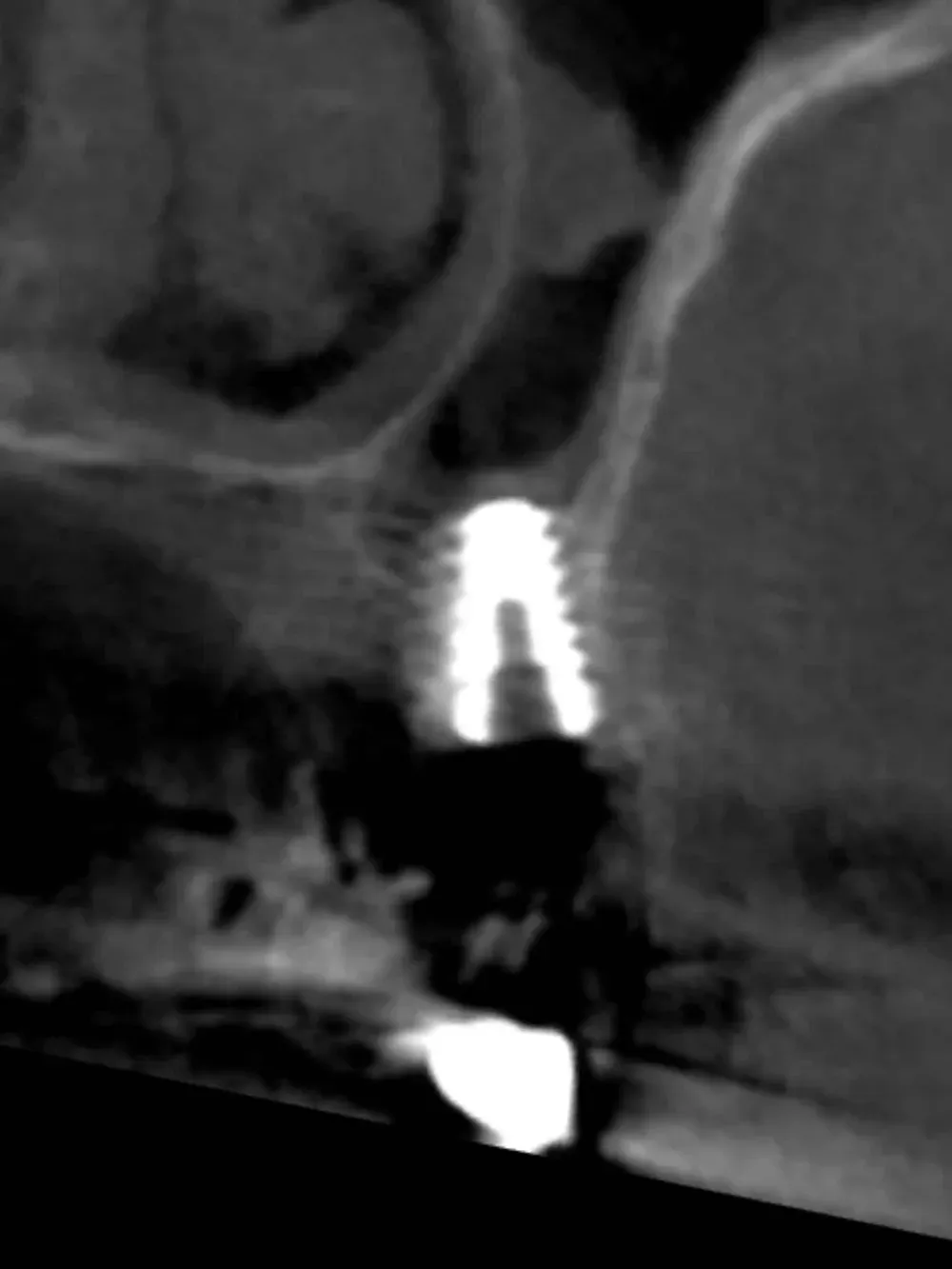 Espansore in posizione 2.5 con sollevamento della corticale del pavimento del seno