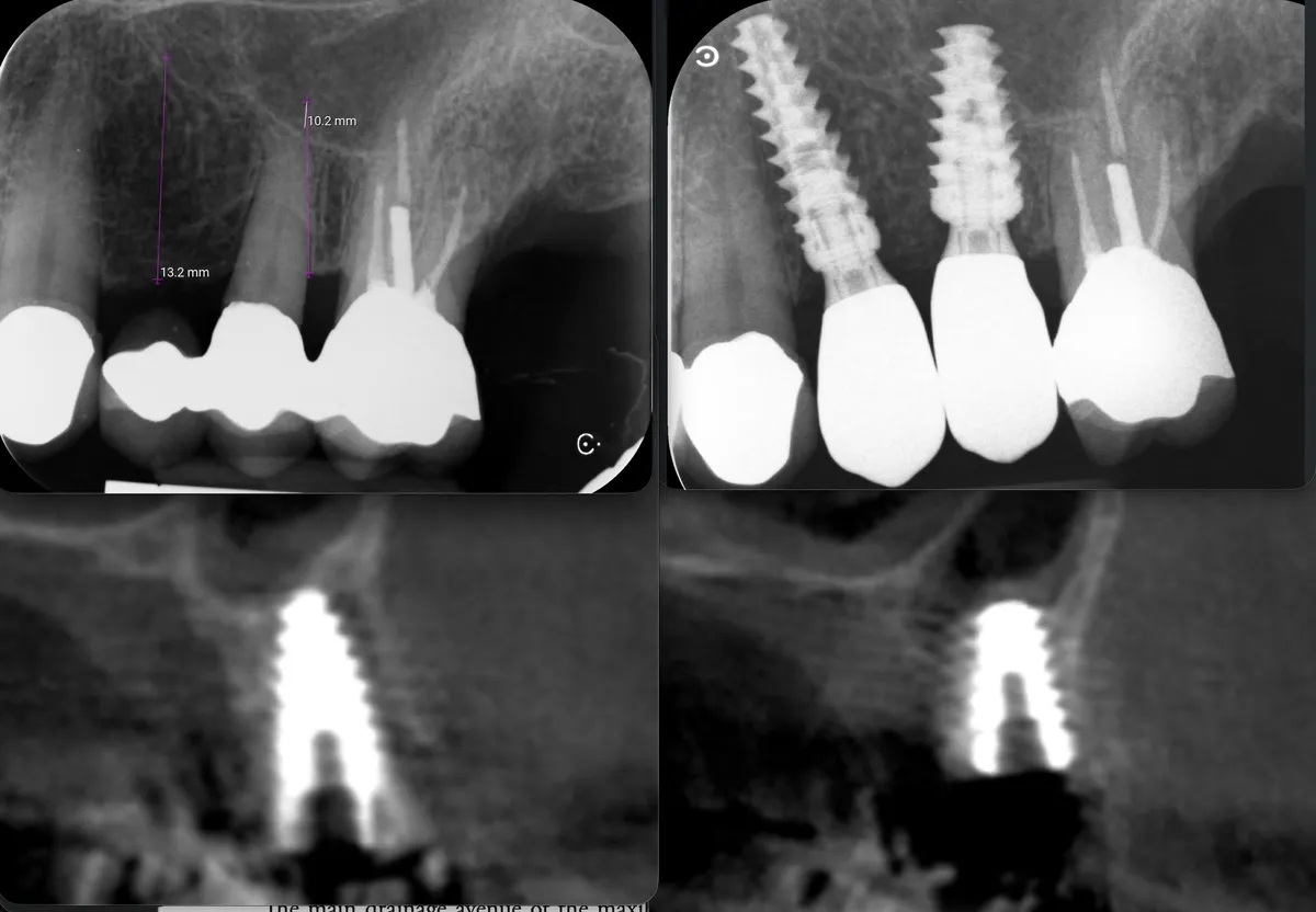 stabilita-di-un-altro-pianeta-minirialzo-e-carico-immediato